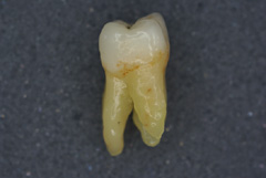 大臼歯03