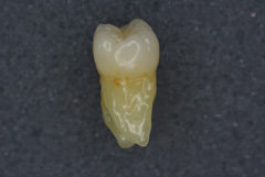 大臼歯06