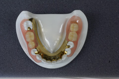 義歯（入れ歯）12